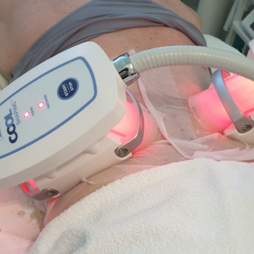 Kryolipolyse - Fett weg mit Kälte